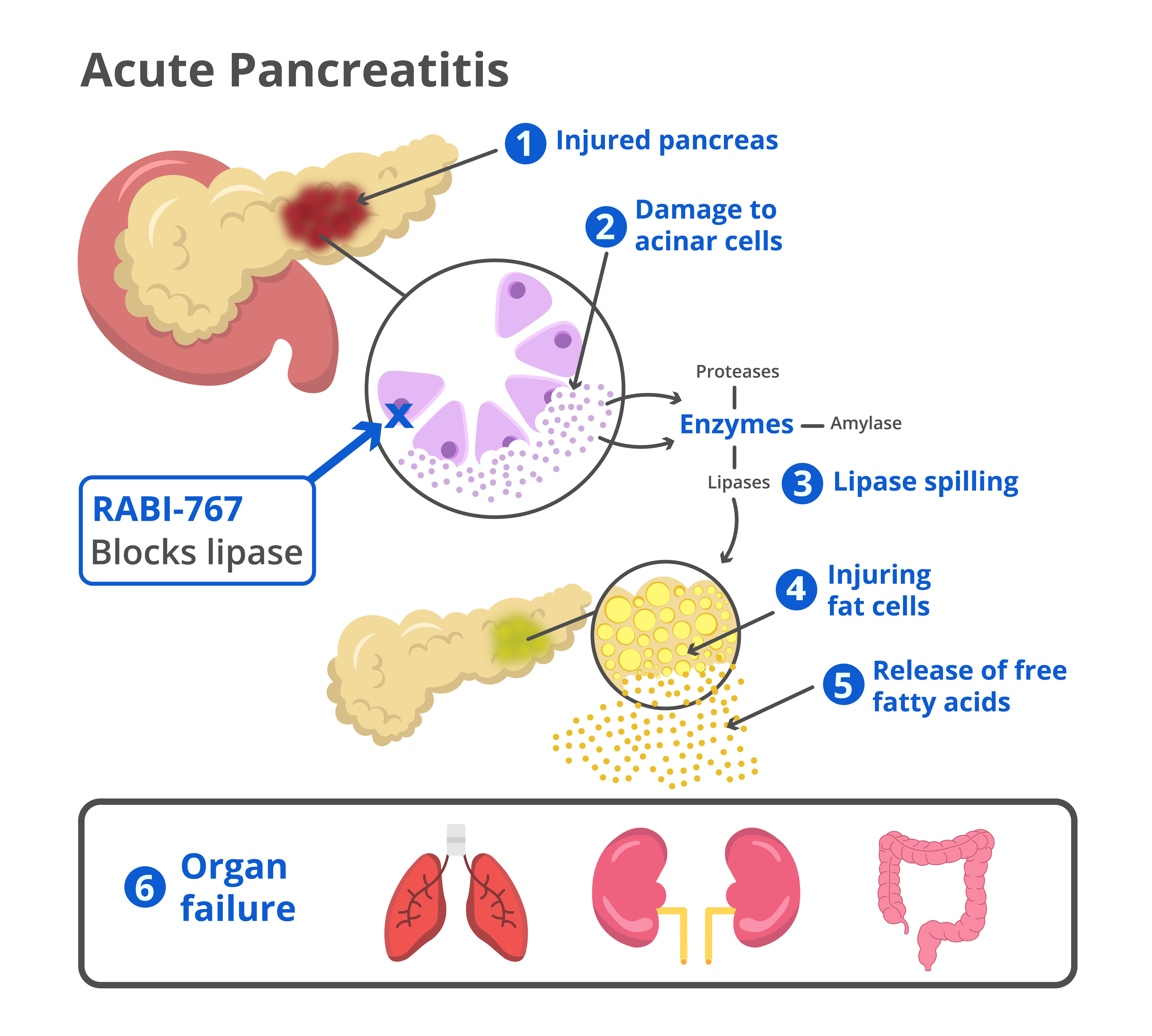 Arrivo graphic showcasing RABI-767 role in acute pancreatitis